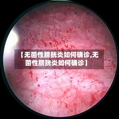【无菌性膀胱炎如何确诊,无菌性膀胱炎如何确诊】-第3张图片