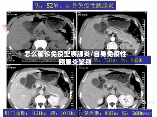 怎么确诊免疫型胰腺炎/自身免疫性胰腺炎鉴别-第2张图片